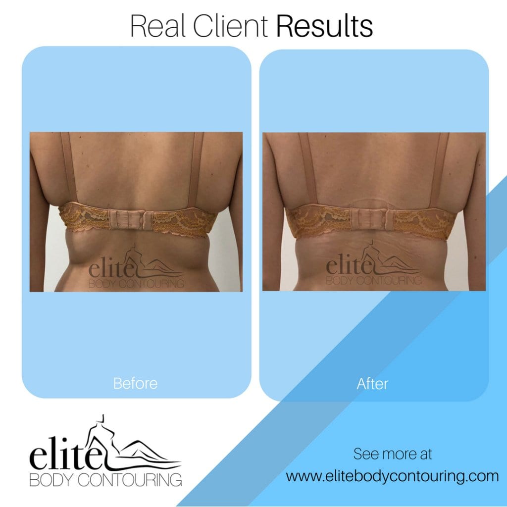 Client Results Elite Body Contouring Before and After Fat Freezing