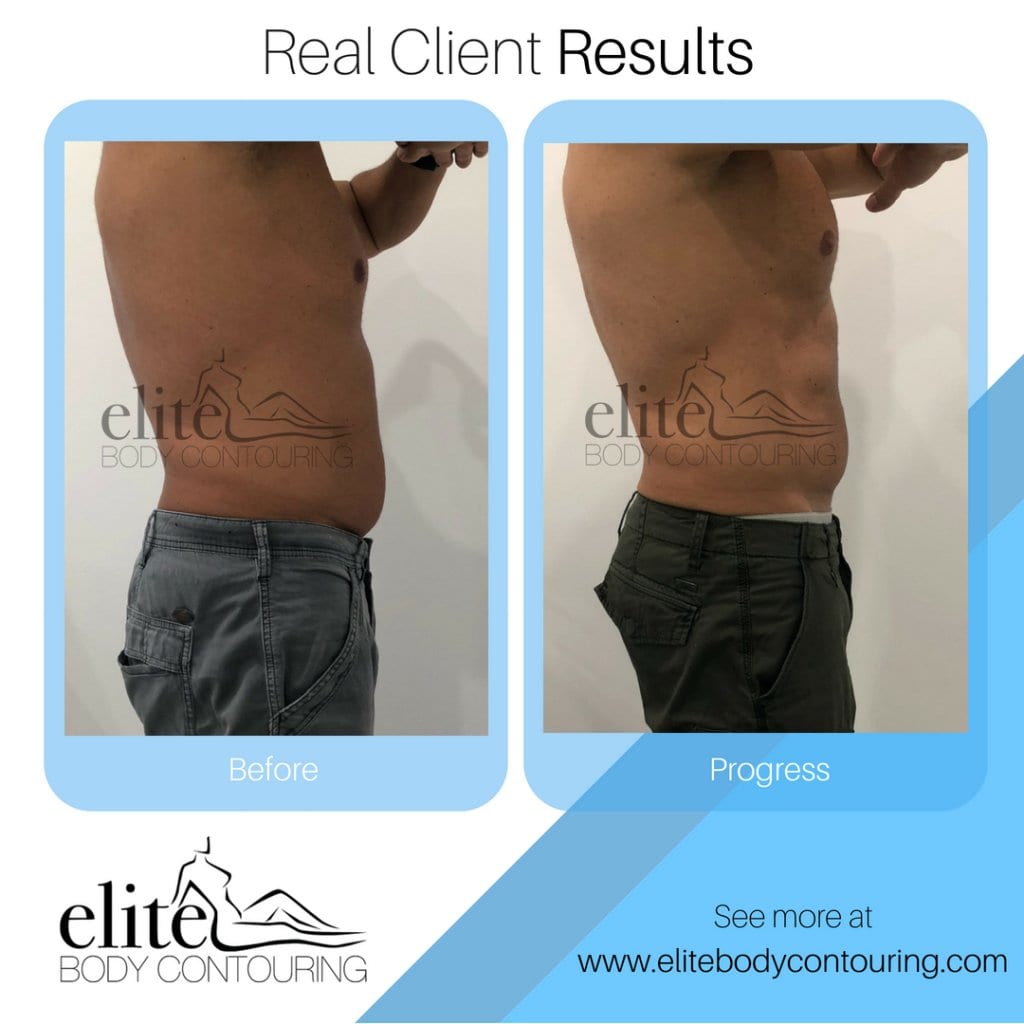 Client Results Elite Body Contouring Before and After Fat Freezing